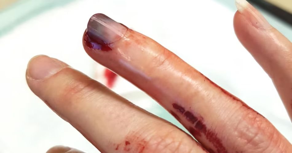 acrylic nails burn