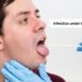 infection under tongue
