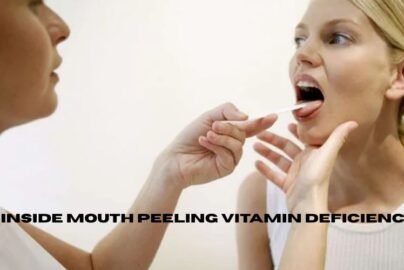 inside mouth peeling vitamin deficiency