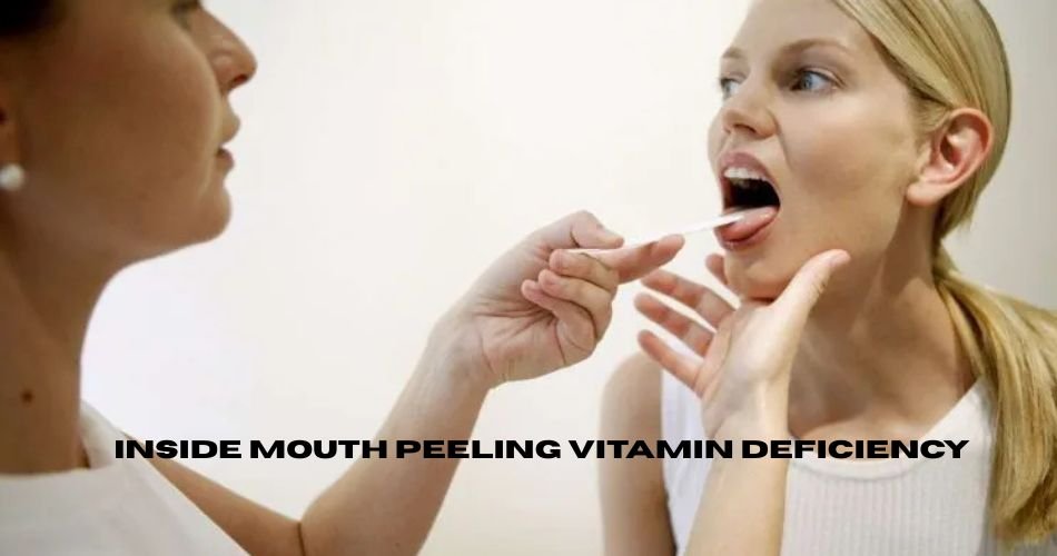 inside mouth peeling vitamin deficiency
