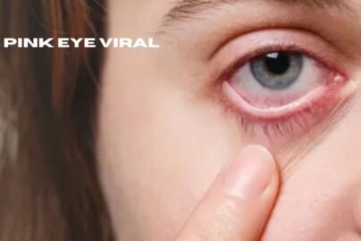 is pink eye viral