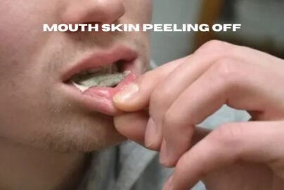 mouth skin peeling off