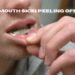 mouth skin peeling off