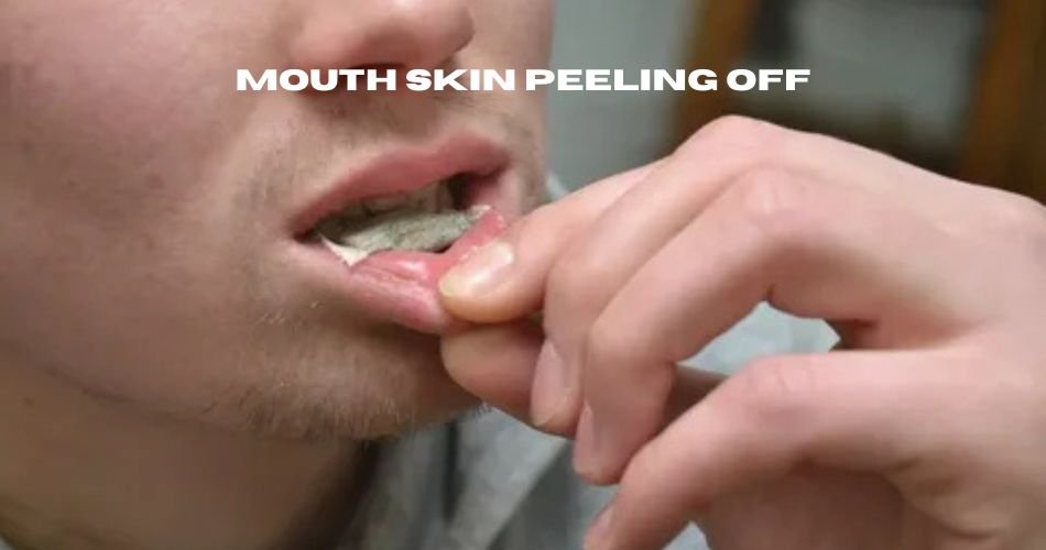 mouth skin peeling off