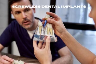 screwless dental implants