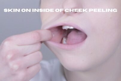 skin on inside of cheek peeling