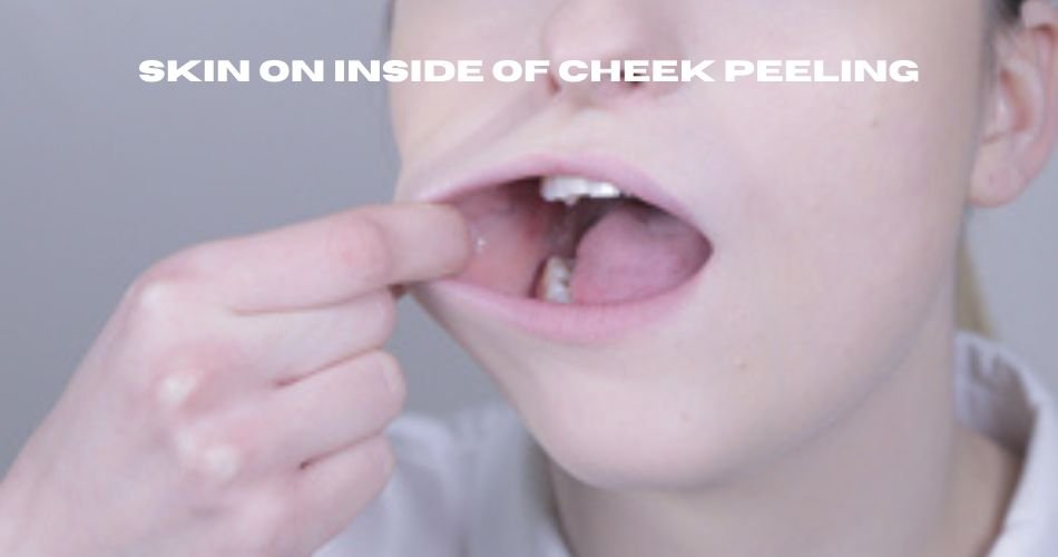 skin on inside of cheek peeling