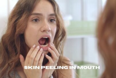 skin peeling in mouth