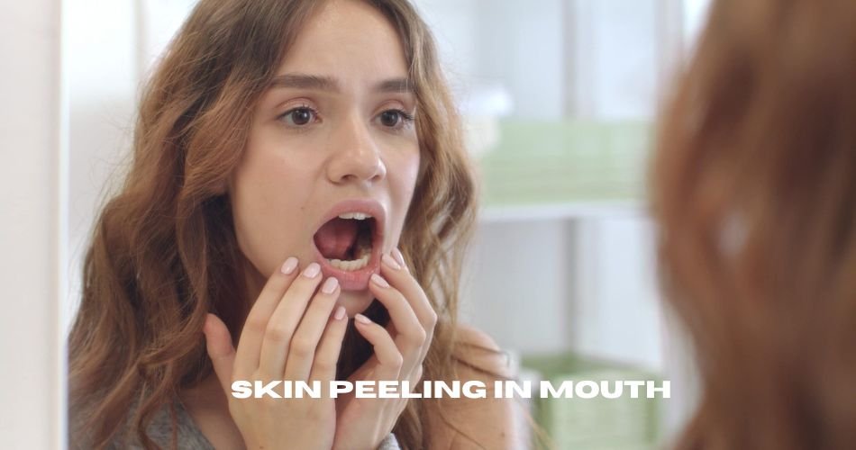 skin peeling in mouth